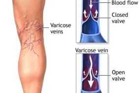 VARICOSE VEINS DRENAGE